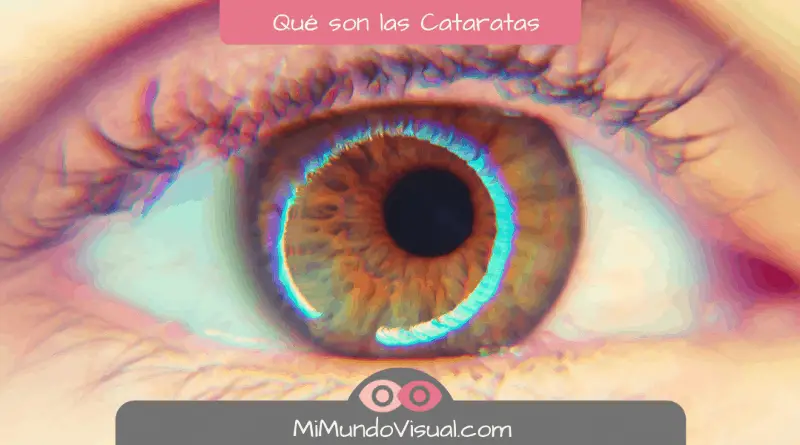 6 Preguntas sobre qué son Cataratas - mimundovisual.com
