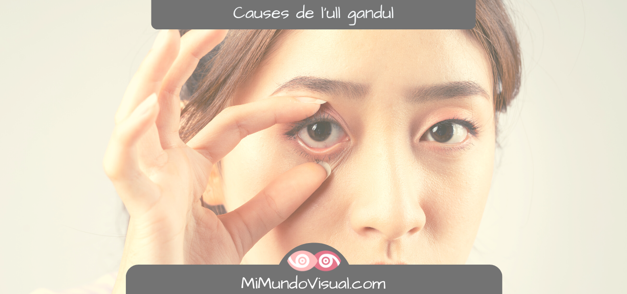 Causes de l'ull gandul - MiMundoVisual.com