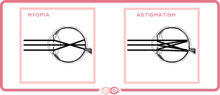 What is the difference between Myopia and Astigmatism? - Mi Mundo Visual
